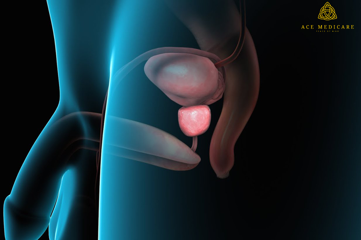Exploring the Latest Breakthroughs in Enlarged Prostate Research